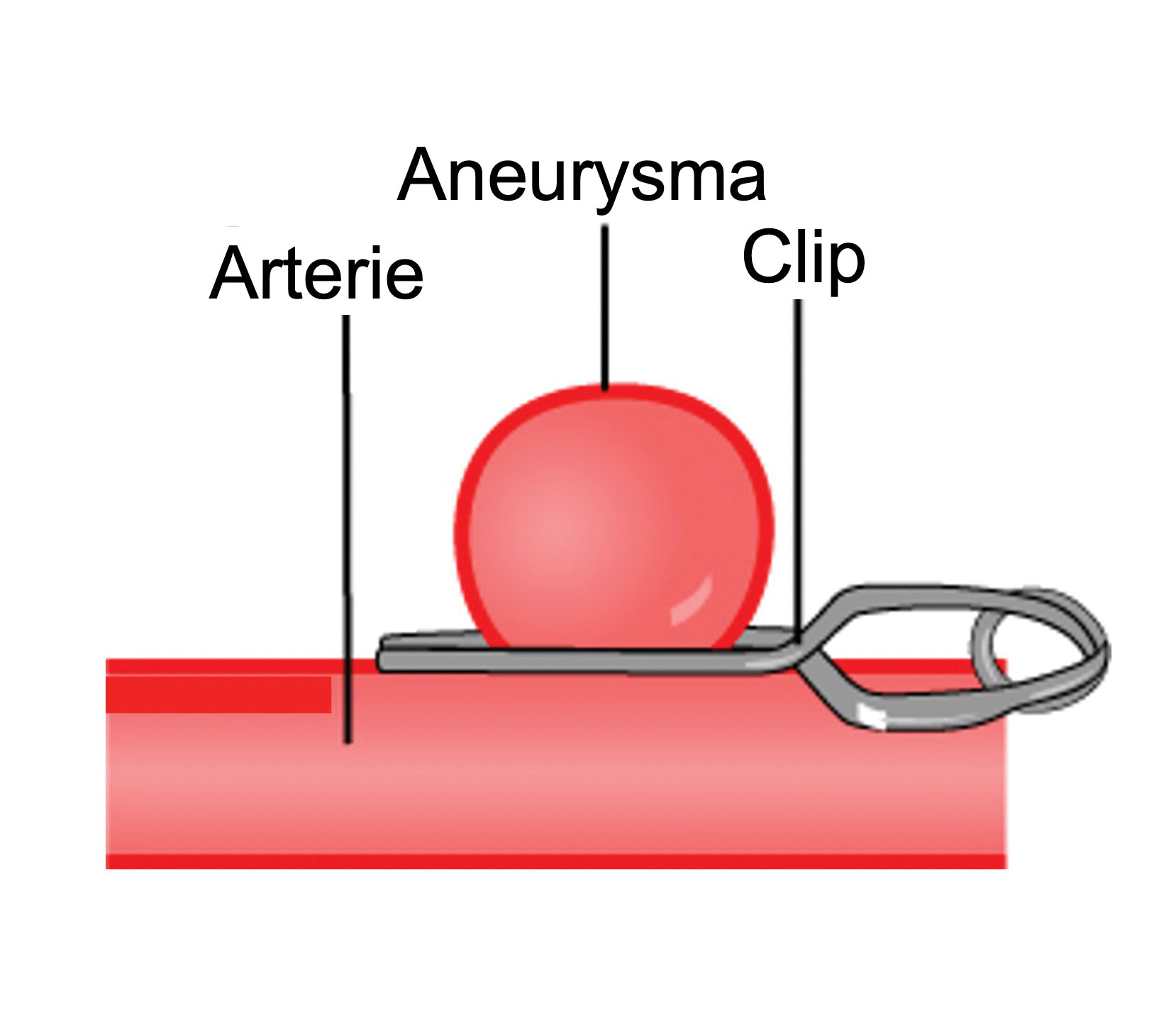 Aneurysma-Clipping<br> / -Coiling